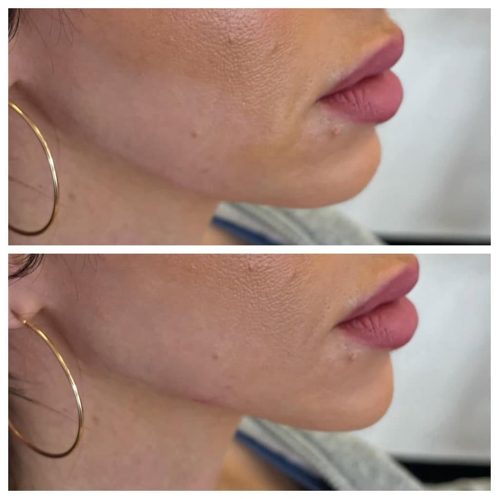 Dermal Filler results