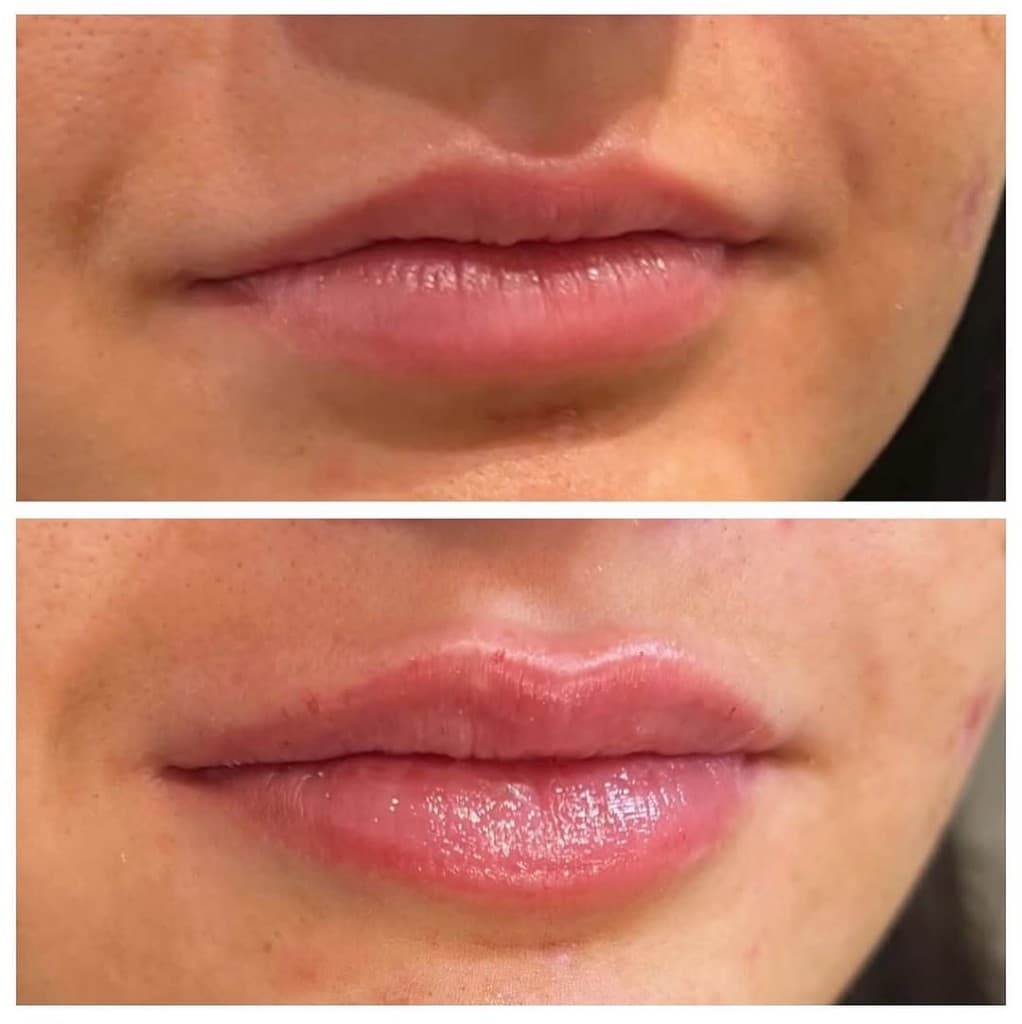 Lip Filler at Artful Aesthetic Medicine, Englewood CO.